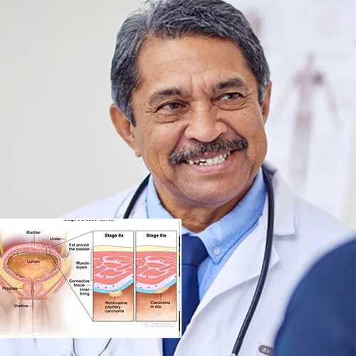 Understanding Penile Implant Options